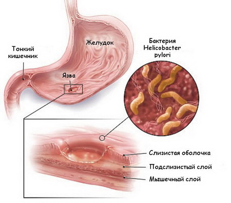 gastrit 3